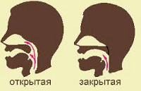 Открытая и закрытая ринолалии